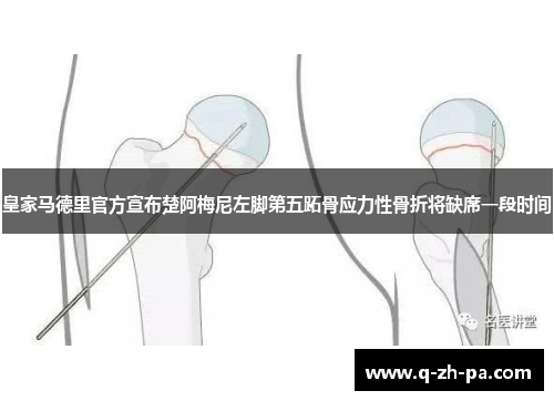 皇家马德里官方宣布楚阿梅尼左脚第五跖骨应力性骨折将缺席一段时间
